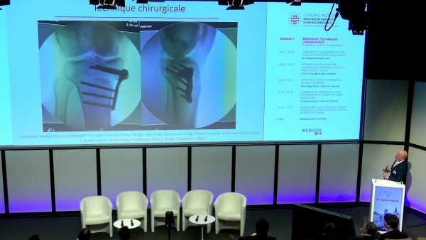 Meniscal transplant surgery with custom cutting guides