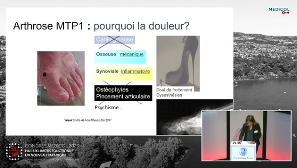 Hallux Rigidus