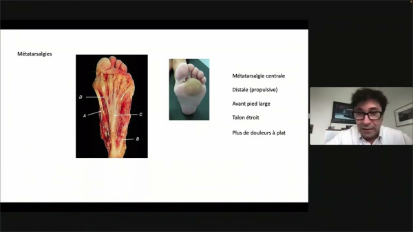 Shortness of the gastrocnemius muscles