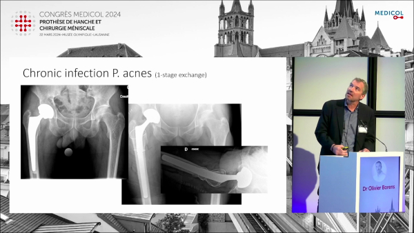 Surgical revisions