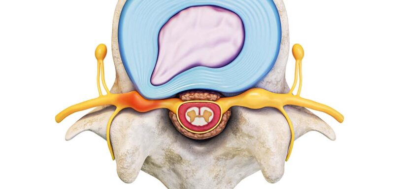 Herniated disc - diagnosis and treatment alternatives - Lausanne