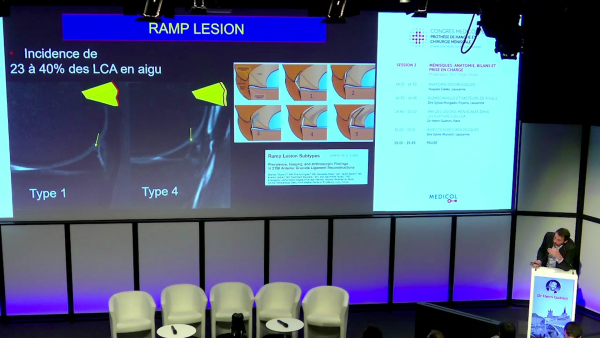 MRI of meniscal lesions in ACL tears