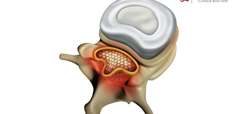 Decompression of a narrow lumbar canal