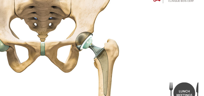 News in hip replacement surgery: planning, short stems and rehabilitation
